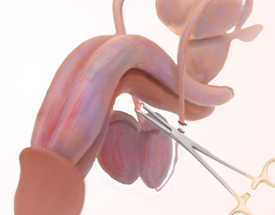 лигаментотомија за зголемување на пенисот