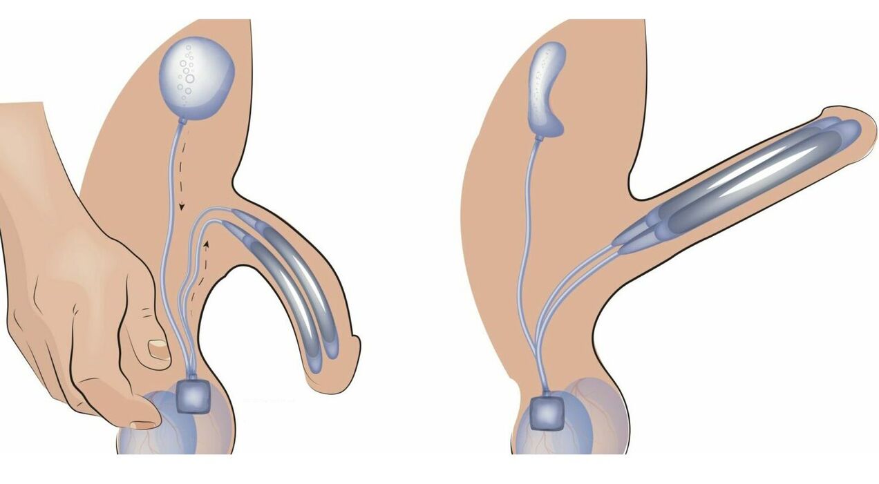 пенис протеза за зголемување на пенисот