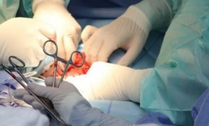 пенисот проширување хирургија